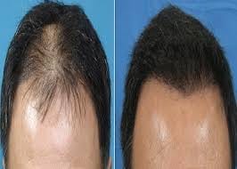 hair loss