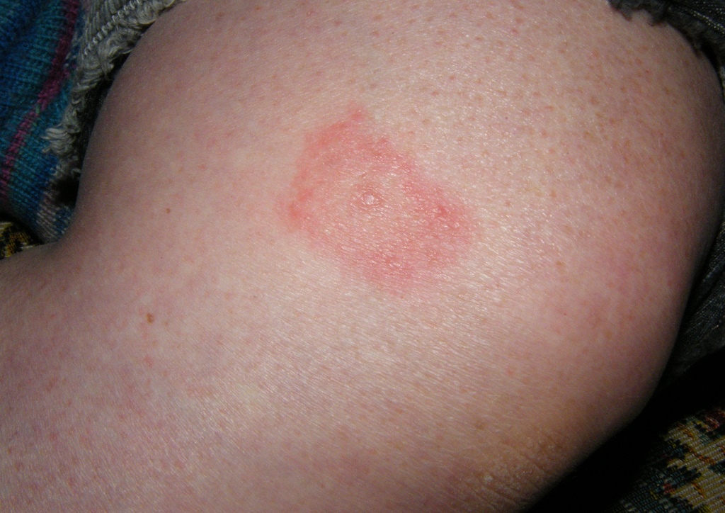 Rash on skin