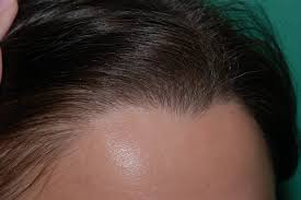 hair loss